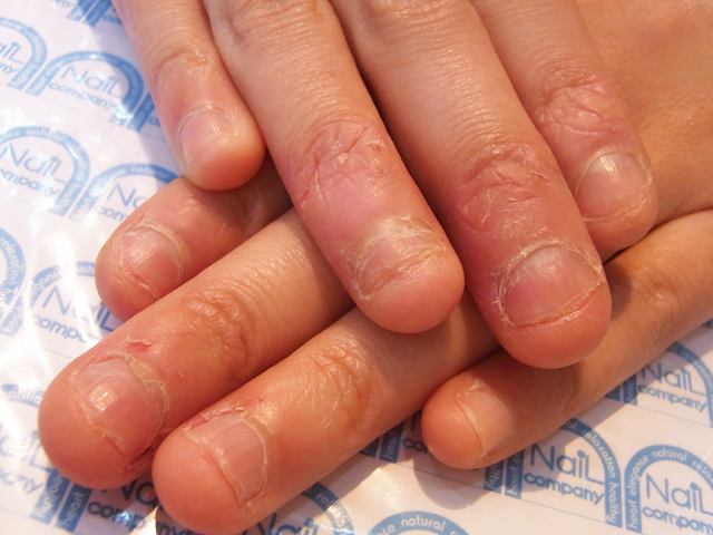 爪を噛むのをやめる6つの方法