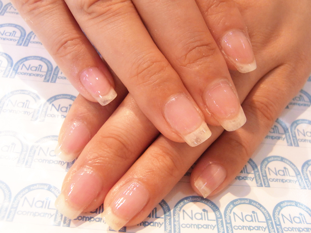 爪が痛い症状にグラスネイルキットを対策した後（After）の画像