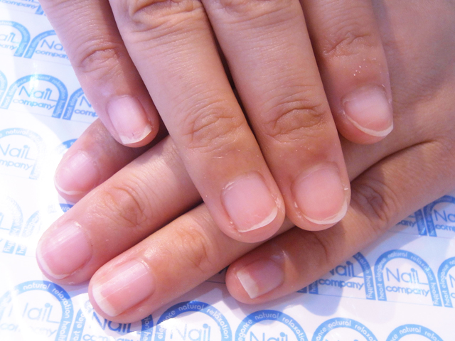 爪が痛い症状にグラスネイルキットを対策する前（Before）の画像