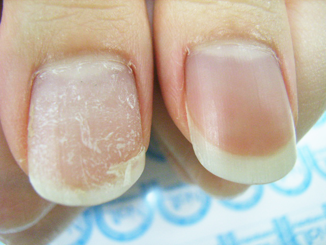 ジェルネイルで傷んだ爪にグラスネイルキットを対策する前（Before）の画像