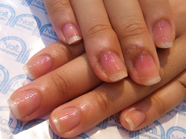 むしった爪1施工後