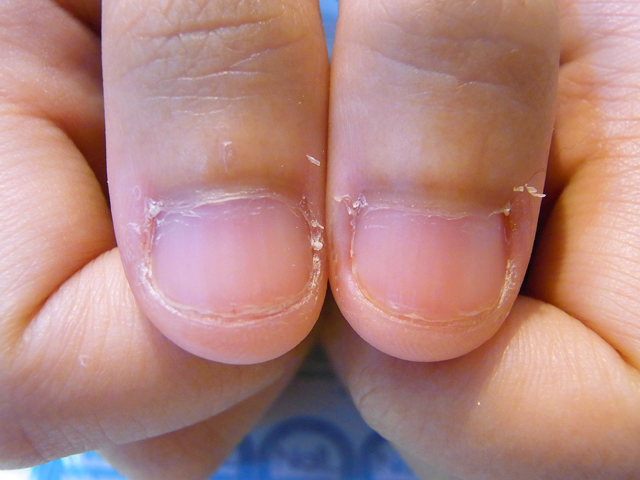むしった爪2施工前