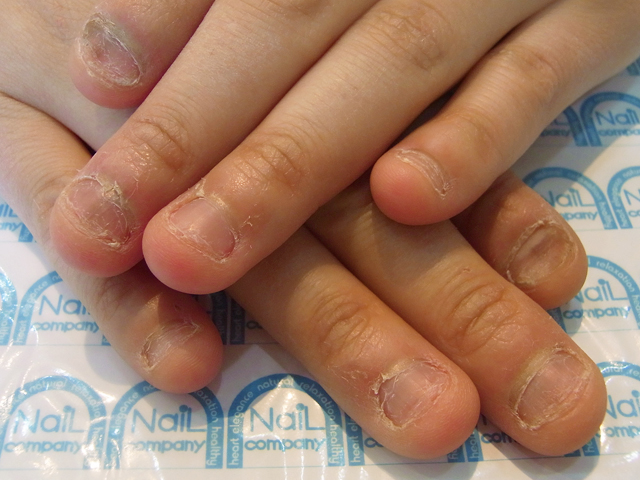 むしった爪3施工前