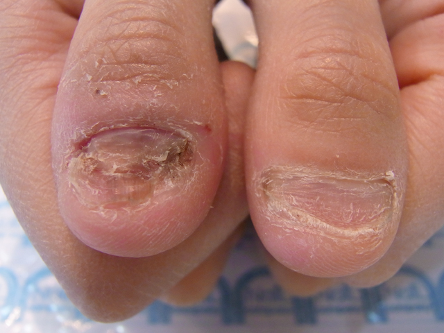 むしった爪4施工前