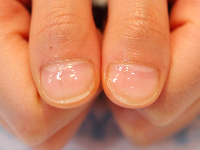 むしった爪4施工後