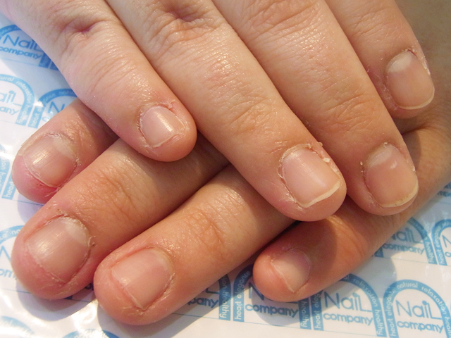 ささくれ1施工前