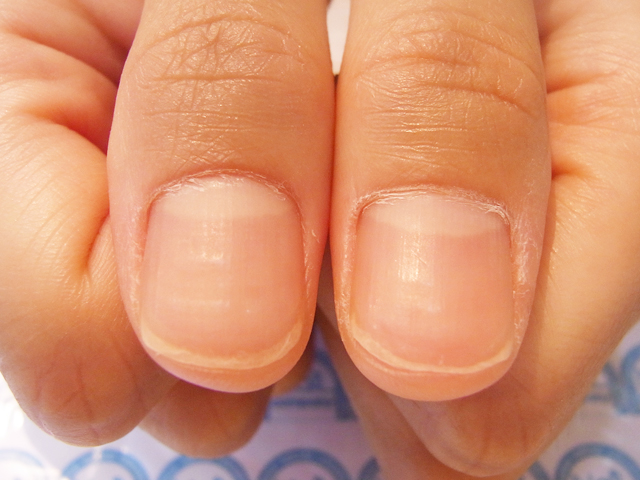 薄い爪3施工前