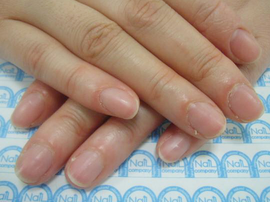 割れる爪1施工前