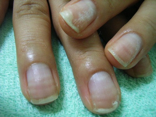 折れる爪1施工前