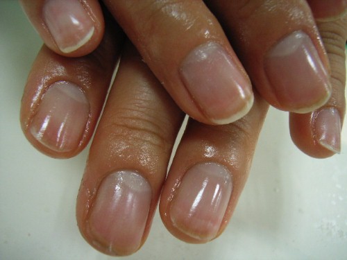 折れる爪1施工後